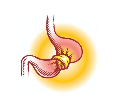 stresz gyomor