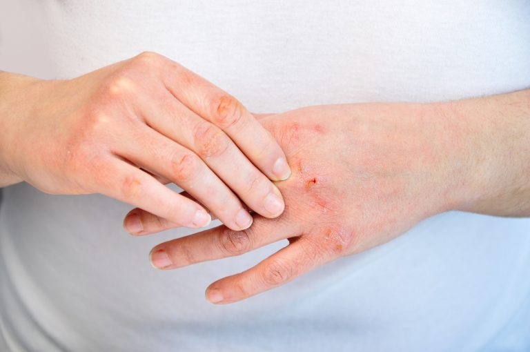 atopias-dermatitisz-ekcema